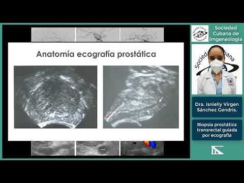 Transrectal prostate biopsy, guided by ultrasound. Dr. Isnielly Virgen Sánchez Gendriz