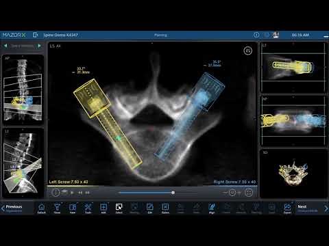 Medtronic | Mazor X Spinal Robotics - Preop Planning, L4-5 Minimally Invasive Spinal Fusion