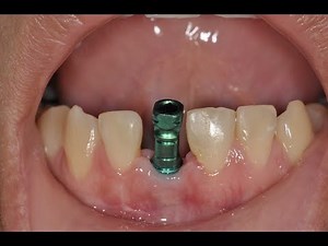 Implant Level Impression (easy method)