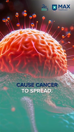 Biopsy Does Not Spread Cancer: Breaking the Myth