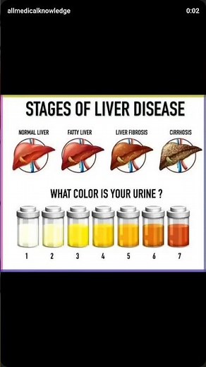 stages of Liver disease #biology #medical #liverdisease #disease #liver