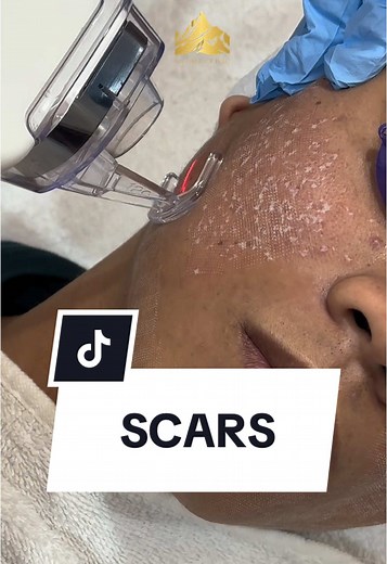 Effective Treatments for Acne Scars: Subcision & CO2 Laser