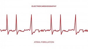 Animated Ekg Display Animated Atrial Fibrillation Stock Footage Video (100% Royalty-free) 1102363911 | Shutterstock