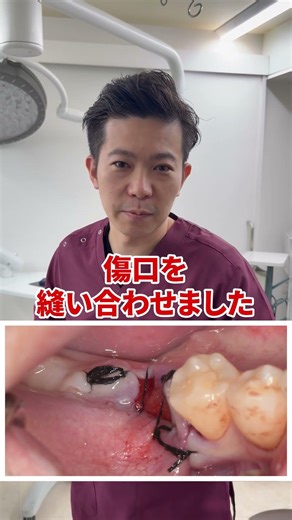 Excruciating pain after wisdom tooth extraction!! What is dry socket!? #FriendlyDentist #DrySocke...