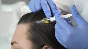 Doctor trichologist making injections mesotherapy with vitamins in woman skin head for hair growth and against dandruff in cosmetology clinic, closeup view. Hairs cure. Trichology in medicine.