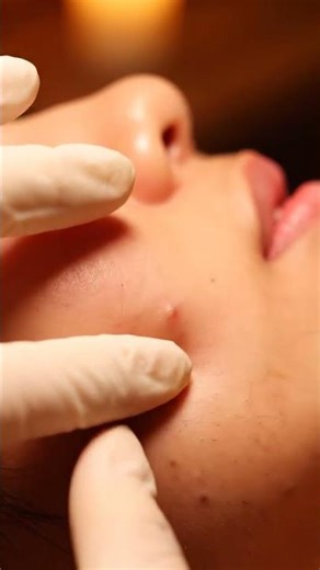 Clinical Vacuum Extraction — Clean Pores Revealed 🧼✨#Clinical #Vacuum #ASMR #Shorts #Skincare #Pores