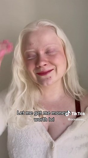 Understanding Albinism and Genetics