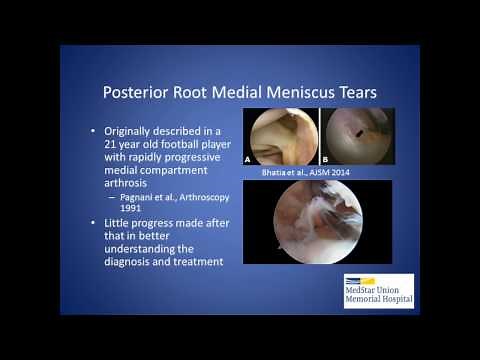 Meniscus Root Tears: Unique Injuries Requiring Anatomic Repair - James Dreese, MD