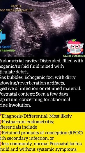Ultrasound: Postpartum Endometritis #ultrasound #radiology #gynecology #endometrium