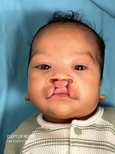 The best part of our week is seeing our patients back, thriving and healthy! | Cleft Lip Dallas