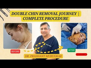 Top Cosmetic Surgeon Shares Best Techniques for Double Chin Removal | part 2