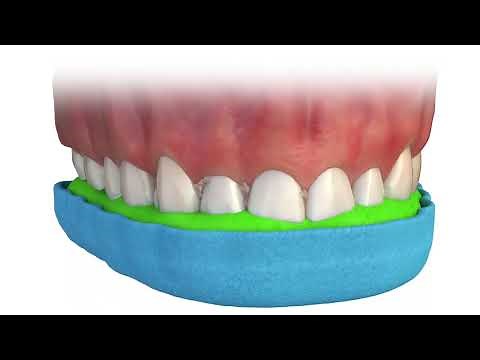 Turbo-CR: A how-to for easy calculus removal.