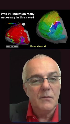 Rhythm Interventions Online | André d’Avila demonstrates substrate-based VT ablation guided by sinus rhythm and coronary sinus pacing, without the need for VT induction.... | Instagram