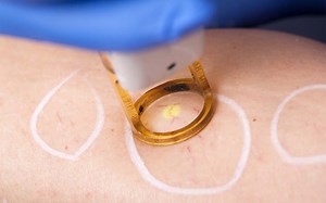 IPL laser for spider veins and varicose veins | Vein Health