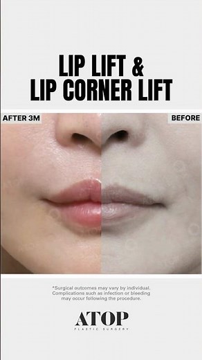 ✨ Lip Lift & Lip Corner Lift Surgery ✨