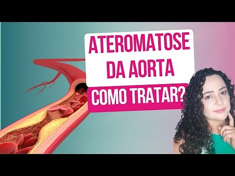 Aortic atheromatosis: understand what it is and learn how it should be treated.