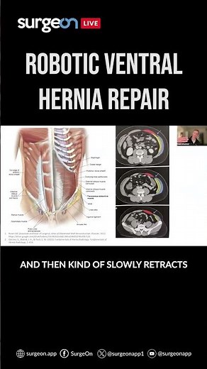 Navigating Complex Robotic Ventral Hernia Repai