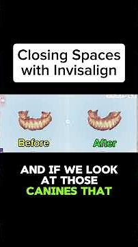 Closing Spaces with Invisalign - A Case Review