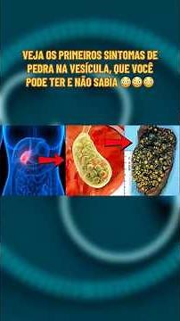 ⚠️ Cholelithiasis: Symptoms, Causes and Treatments - Gallstones and Their Signs