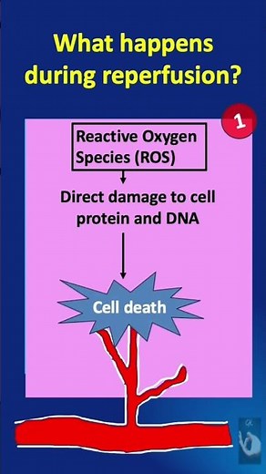 Shorts # 119: Ischemia-Reperfusion Injury (IRI) - What happens during the reperfusion phase?