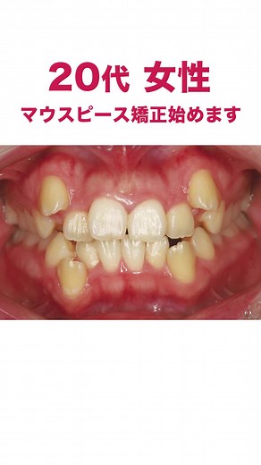 マウスピース矯正とは？マウスピース矯正の効果と過程について詳しく解説