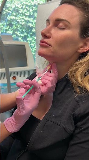 Nefertiti Neck Lift and Platysmal Band Treatment | Changes Plastic Surgery & Spa