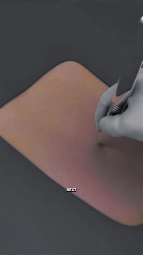 122K views · 1.1K reactions | Endoscopic Lumbar Discectomy #spine #surgeon | Donnallyspineconsult | Facebook