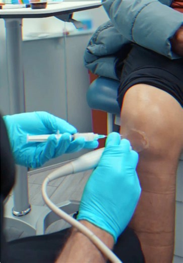 How to alleviate knee pain? Knee steroid injections reduce inflammation and pain so you can fully commit to physical therapy. The anti-inflammatory relief creates a crucial window where you can perform strengthening exercises without debilitating discomfort. With reduced swelling and pain, PT becomes more effective—you can build quadriceps strength, improve flexibility, and work on the movements that support long-term knee health. The injection provides relief; PT provides results. #painrelief #