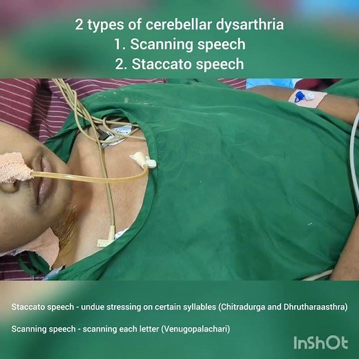 Cerebellar dysarthria | Scanning speech and Staccato speech | @Dr.KamaleshTN_MediCal_Lectures
