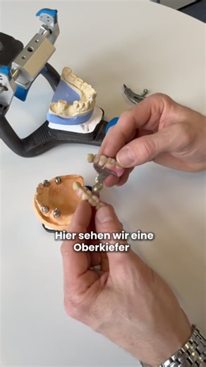 Oberkiefer-Teleskopprothese: Effizienter Zahnersatz