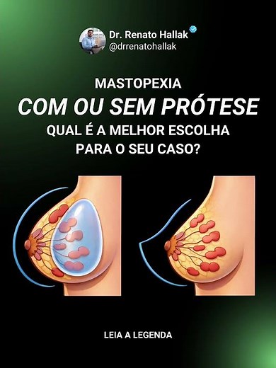 Mastopexia com ou sem prótese: qual é a diferença? #drrenatohallak #cirurgiaplastica