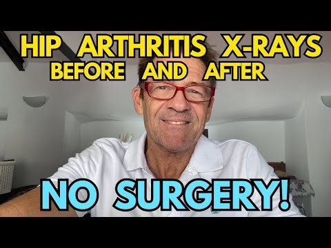HIP OSTEOARTHRITIS XRAYS BEFORE AND AFTER - NO SURGERY #hiparthritis #osteoarthritis