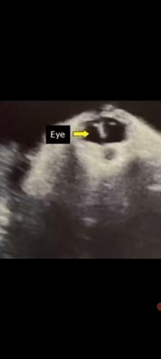 Cyclopia.It congenital disease. Single central Eye.Sign and Symptoms. Awerenes of of All