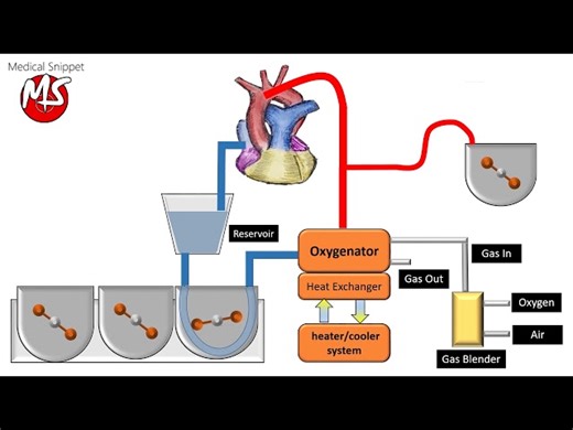 Understanding the Cardiopulmonary Bypass Circuit and Its Components in Cardiac Surgery