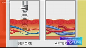 Learn about acoustic wave therapy