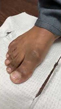 MINIMALLY INVASIVE CHEILECTOMY SURGERY FOR ARTHRITIS OF THE GREAT TOE JOINT (Hallux Limitus) 👣👣👣