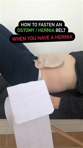 How to fasten an Ostomy / Hernia belt when you have a hernia? . 1️⃣ Lay down for 10 min (approximately). This is very important because the hernia should be inside the abdominal cavity before fastening the belt. That way when the belt is attached, it will prevent the hernia to pop out. . 2️⃣ Fold and feed the pouch. . 3️⃣ Make sure the tabs are kept behind the ring. . 4️⃣ Voilà! You are ready to go. . Double tap! ❤️ . . . #hernipro #hernia #ostomy #ostomybelt #herniabelt #madeincanada #herniasup