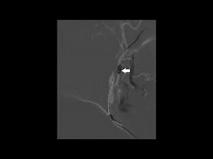 Nuances of carotid artery stenting under flow arrest with dual-balloon guide catheter