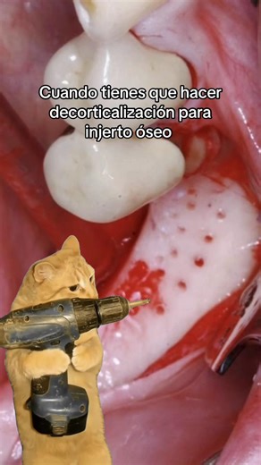 Se realiza para estimular la cicatrización, mejorar la integración de injertos y potenciar la formación de nuevo tejido óseo 🦷🤟🏻 Agenda tu cita 🦷 en📍Tijuana 📱6643105906 🇲🇽/6192098812 🇺🇸 Aceptamos seguro dental PPO ✅ Dra Ilse Alcina Tostado UABC-CP: 8676935 COFEPRIS: 240202200A00083 #dentisttijuana #dentalimplants #allon4 #implantedental #dentalinsurance