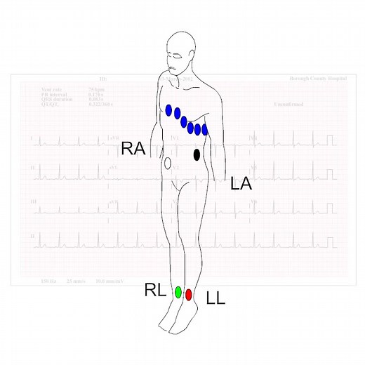 How to Spot Electrode Misplacement - Learn more at https://acadoodle.com #emergencymedicine #intensivecare #respiratory #respiratorycare #icu #nurses #icunurse #ecg #ekg #cme #cmeonline | ECG Teacher