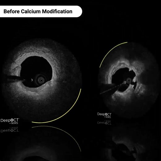 DeepOCT+NIRS Imaging of Calcium Modification