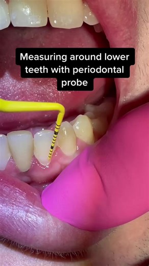 Measuring Around Lower Teeth with Periodontal Probe