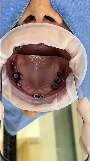 Full Implant Scanbody #dentist #dental #dentistry #dentalartistry #implants #dentalprosthesis