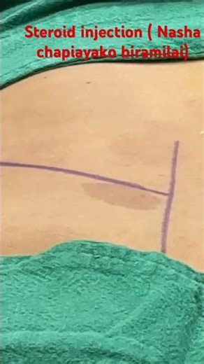 # Transforaminal steroid injection