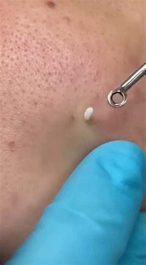 Pimple Popping ASMR #shorts #blackheads #acne #pimple