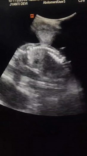 Asymptomatic patient came for routine usg. What's your sonographic finding? #goviral #fyp #ImagingSolutions | Isaac Owusu Banahene