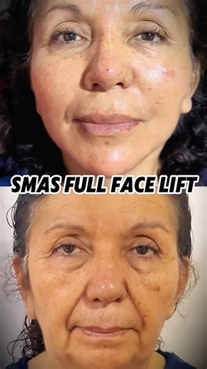 Precision matters more than tension. #AestheticSurgery #antiaging