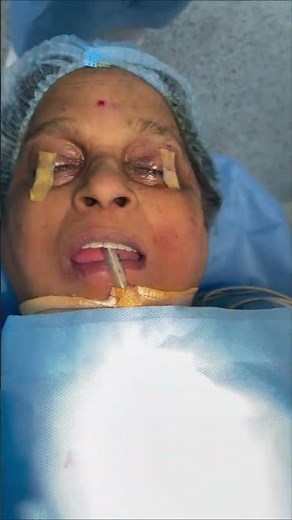 HEMANGIOMA EXCISION DONE