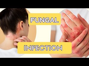 Know its SYMPTOMS, TREATMENT AND HOME REMEDIES!!!!