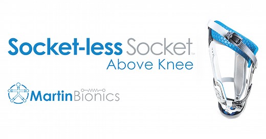 Above Knee Socket-less Socket™ — Martin Bionics
